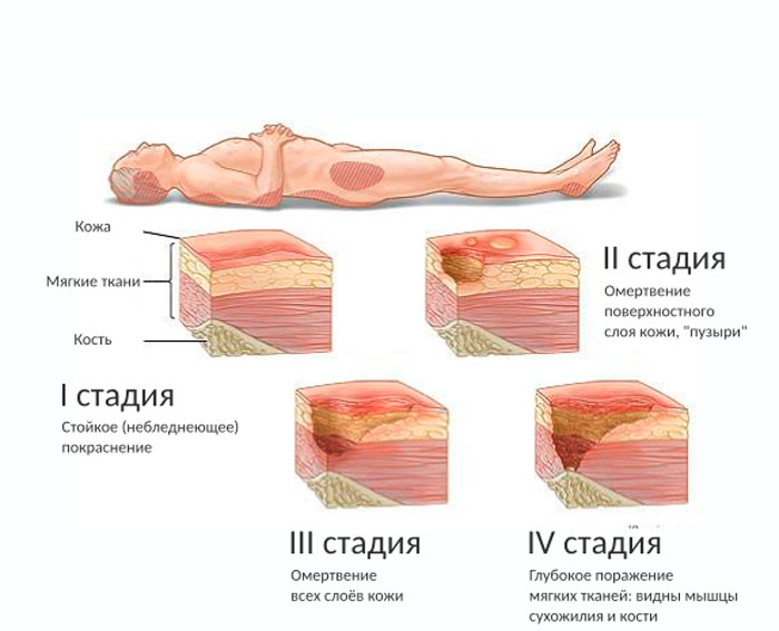 Мазь или крем от пролежней